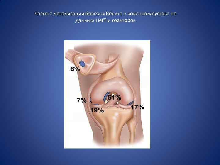 Частота локализации болезни Кёнига в коленном суставе по данным Heffi и соавторов 