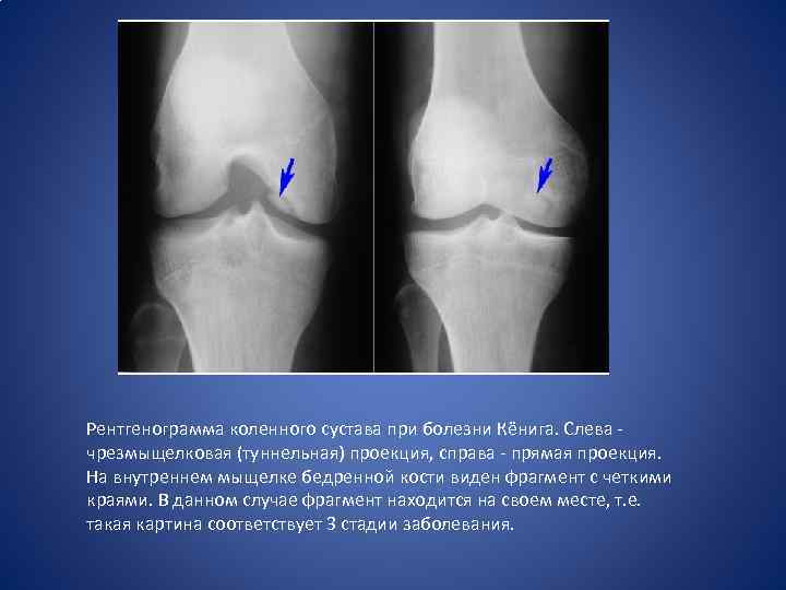 Рентгенограмма коленного сустава при болезни Кёнига. Слева - чрезмыщелковая (туннельная) проекция, справа - прямая