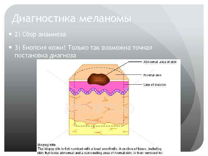 Уровни инвазии меланомы по кларку