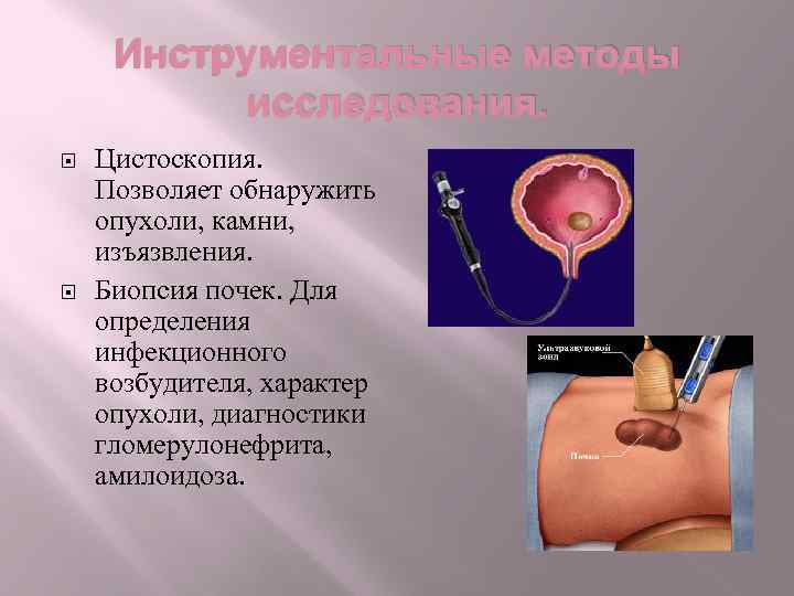 Инструментальные методы исследования. Цистоскопия. Позволяет обнаружить опухоли, камни, изъязвления. Биопсия почек. Для определения инфекционного