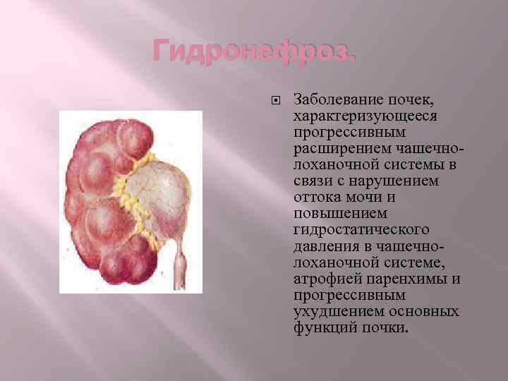 Гидронефроз. Заболевание почек, характеризующееся прогрессивным расширением чашечнолоханочной системы в связи с нарушением оттока мочи
