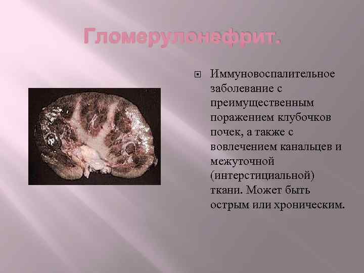 Гломерулонефрит. Иммуновоспалительное заболевание с преимущественным поражением клубочков почек, а также с вовлечением канальцев и