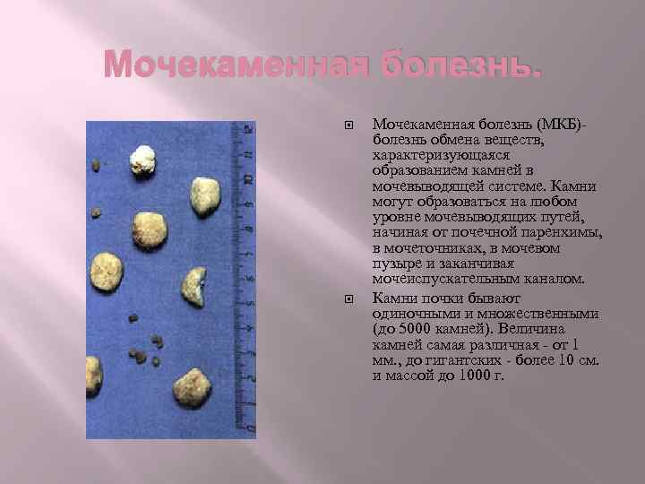 Мочекаменная болезнь. Мочекаменная болезнь (МКБ)- болезнь обмена веществ, характеризующаяся образованием камней в мочевыводящей системе.