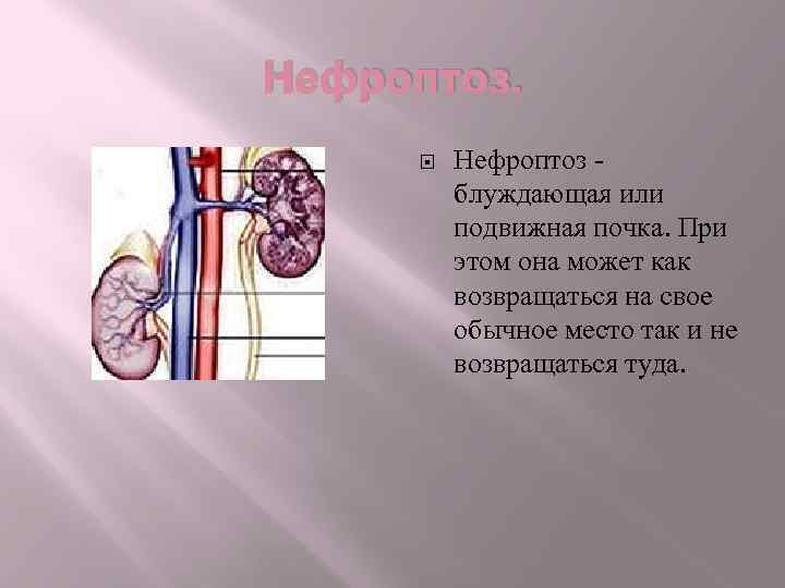 Нефроптоз - блуждающая или подвижная почка. При этом она может как возвращаться на свое