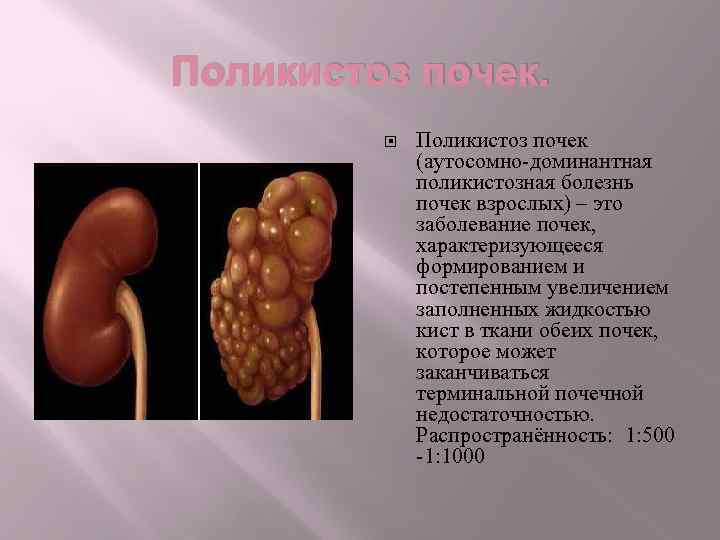 Поликистоз почек (аутосомно-доминантная поликистозная болезнь почек взрослых) – это заболевание почек, характеризующееся формированием и
