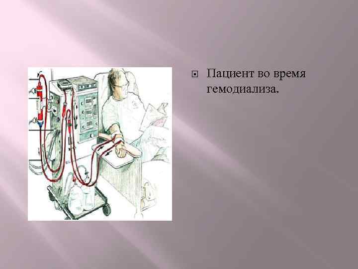  Пациент во время гемодиализа. 