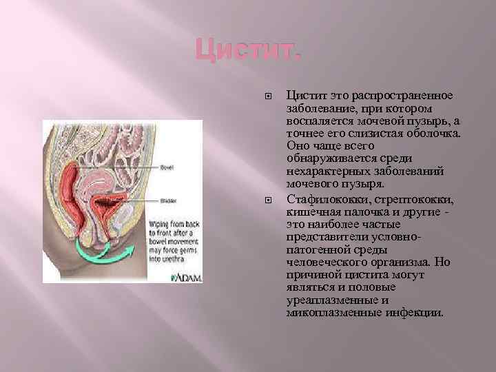 Цистит. Цистит это распространенное заболевание, при котором воспаляется мочевой пузырь, а точнее его слизистая