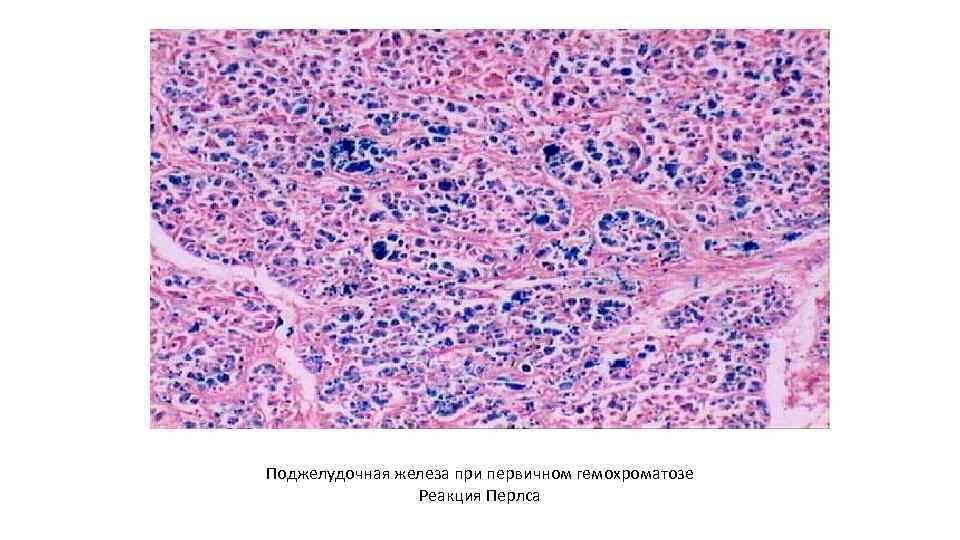 Поджелудочная железа при первичном гемохроматозе Реакция Перлса 