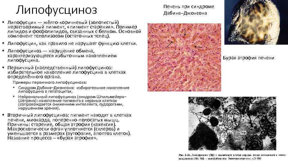 Липофусциноз • Липофусцин — жёлто коричневый (золотистый) нерастворимый пигмент, «пигмент старения» . Полимер липидов
