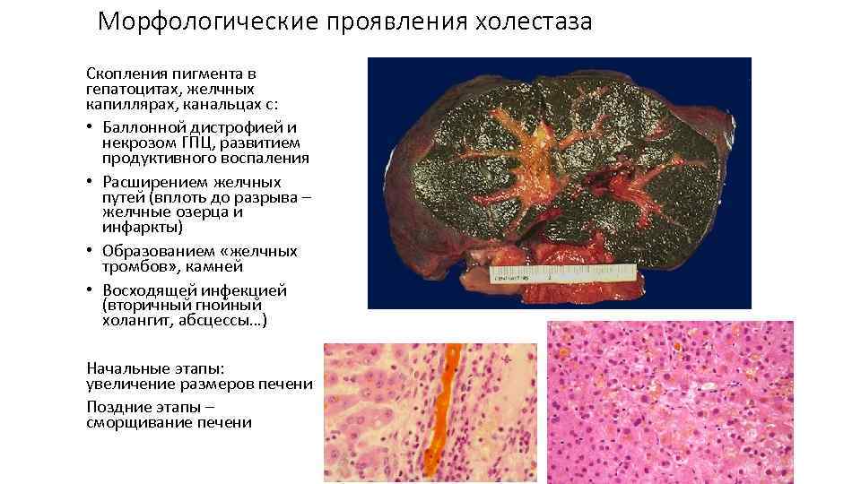 Морфологические проявления холестаза Скопления пигмента в гепатоцитах, желчных капиллярах, канальцах с: • Баллонной дистрофией