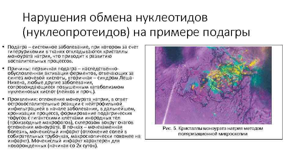 Нарушения обмена нуклеотидов (нуклеопротеидов) на примере подагры • Подагра – системное заболевание, при котором