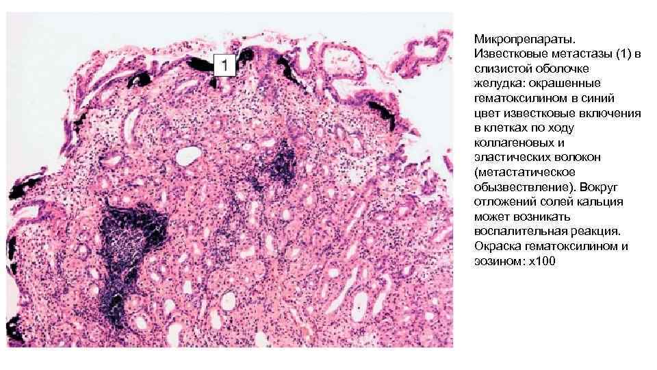 Микропрепараты. Известковые метастазы (1) в слизистой оболочке желудка: окрашенные гематоксилином в синий цвет известковые