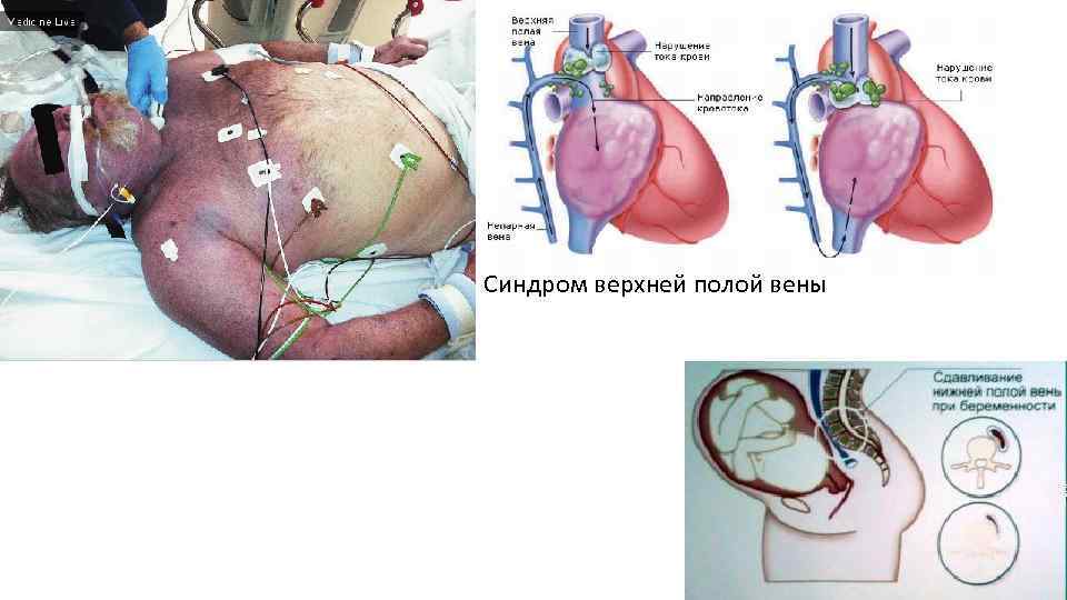 Синдром верхней полой вены 