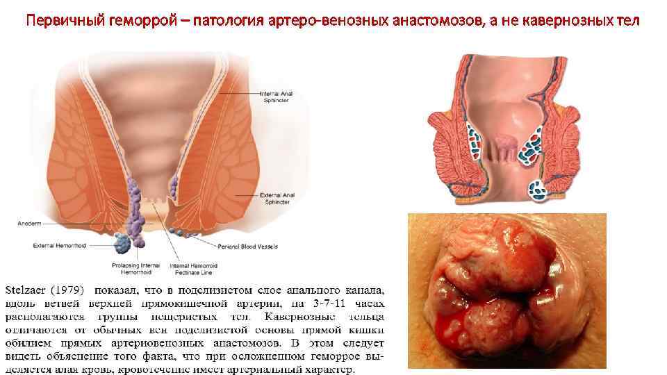 Первичный геморрой – патология артеро-венозных анастомозов, а не кавернозных тел 