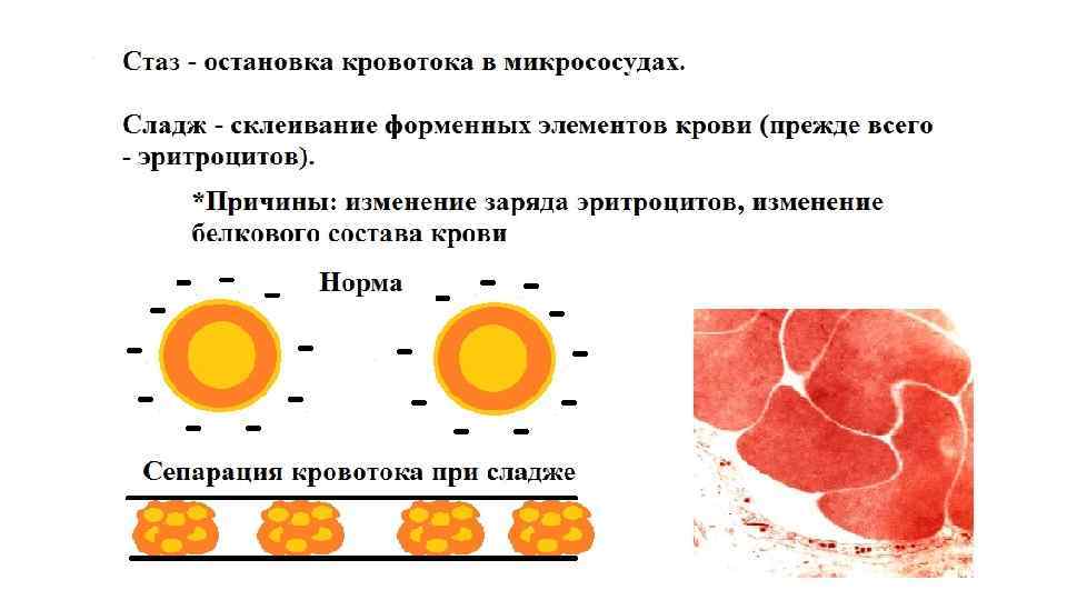 Сладж синдром рисунок