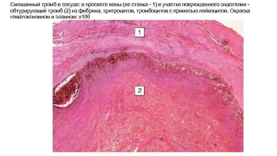Смешанный тромб в сосуде: в просвете вены (ее стенка - 1) в участке поврежденного