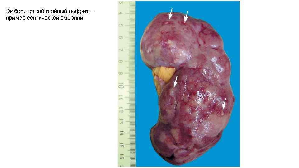 Эмболический гнойный нефрит – пример септической эмболии 