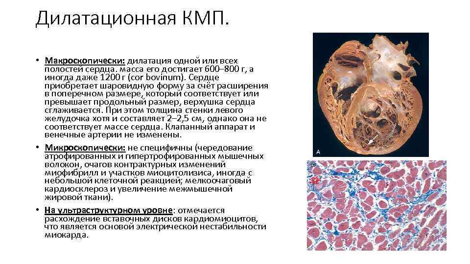 Дилатационная КМП. • Макроскопически: дилатация одной или всех полостей сердца. масса его достигает 600–