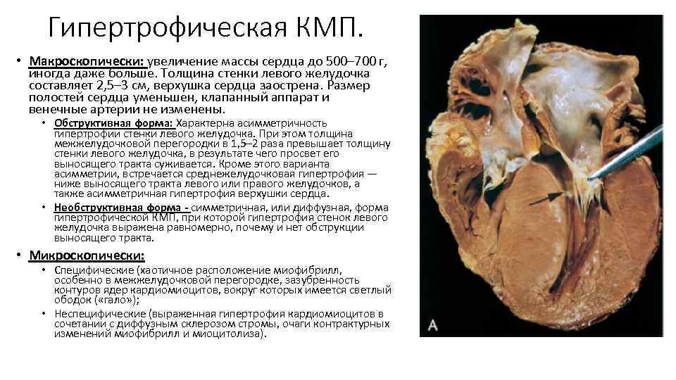 Гипертрофическая КМП. • Макроскопически: увеличение массы сердца до 500– 700 г, иногда даже больше.