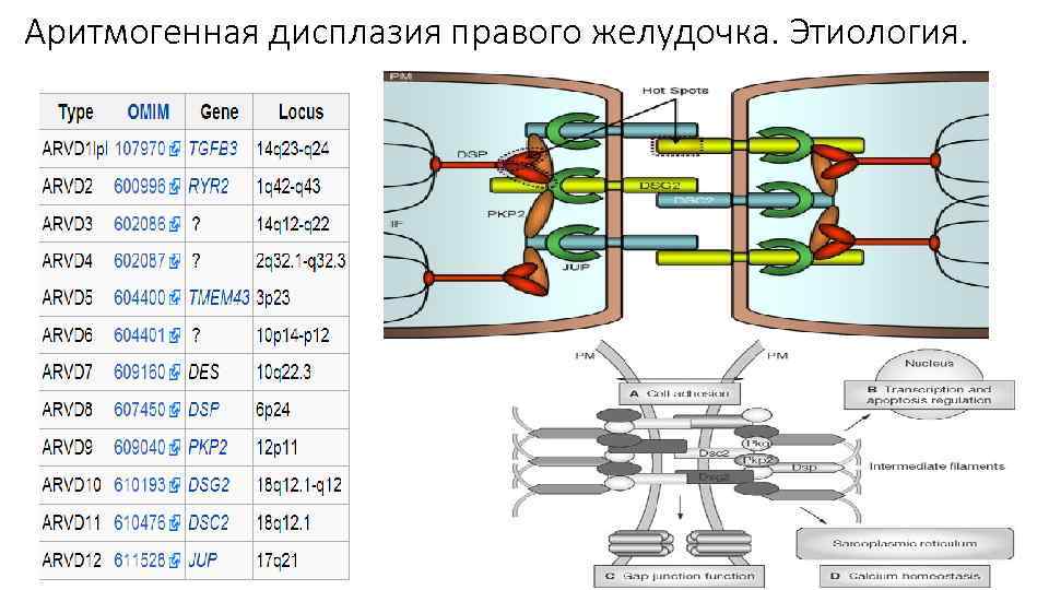 Аритмогенная дисплазия правого желудочка. Этиология. 