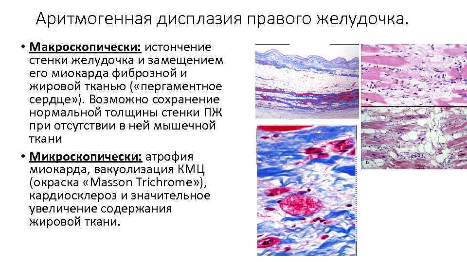 Аритмогенная дисплазия правого желудочка. • Макроскопически: истончение стенки желудочка и замещением его миокарда фиброзной