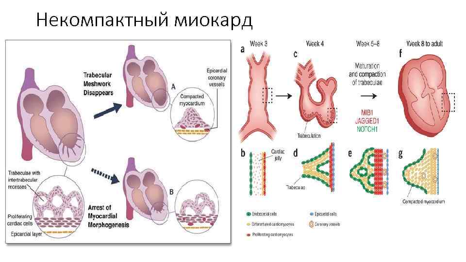 Некомпактный миокард 