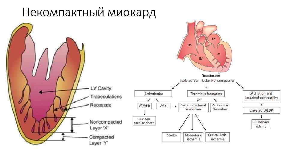 Некомпактный миокард 