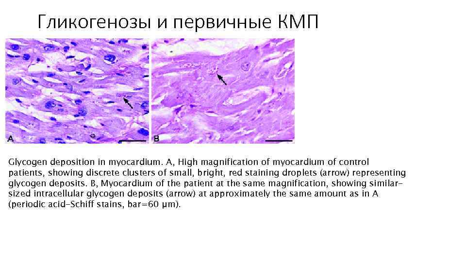 Гликогенозы и первичные КМП Glycogen deposition in myocardium. A, High magnification of myocardium of