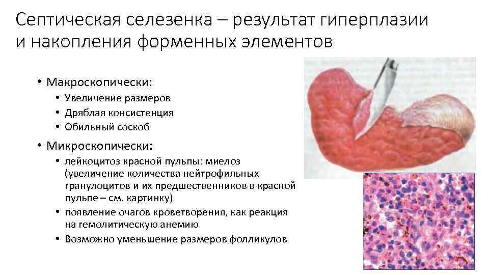 Септическая селезенка – результат гиперплазии и накопления форменных элементов • Макроскопически: • Увеличение размеров