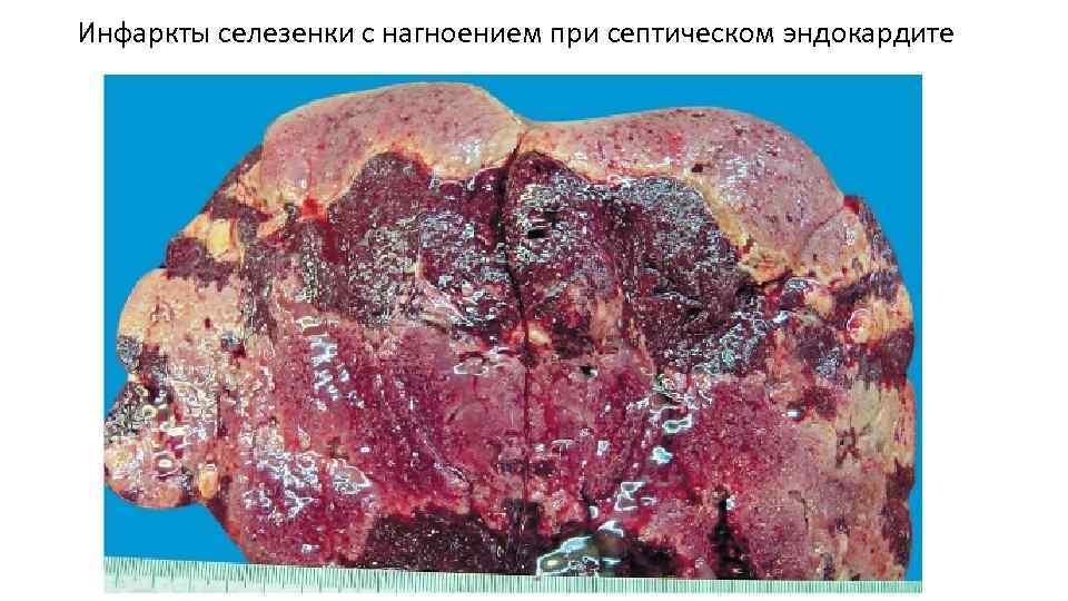 Инфаркты селезенки с нагноением при септическом эндокардите 
