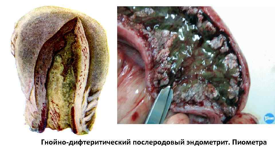 Гнойно-дифтеритический послеродовый эндометрит. Пиометра 