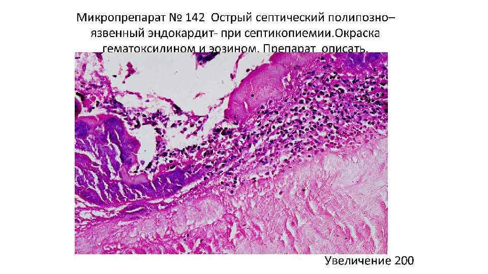 Пауков патологическая анатомия. Бородавчатый эндокардит патанатомия. Септический эндокардит патанатомия. Инфекционный эндокардит гистология. Полипозно-язвенный эндокардит микропрепарат патанатомия.