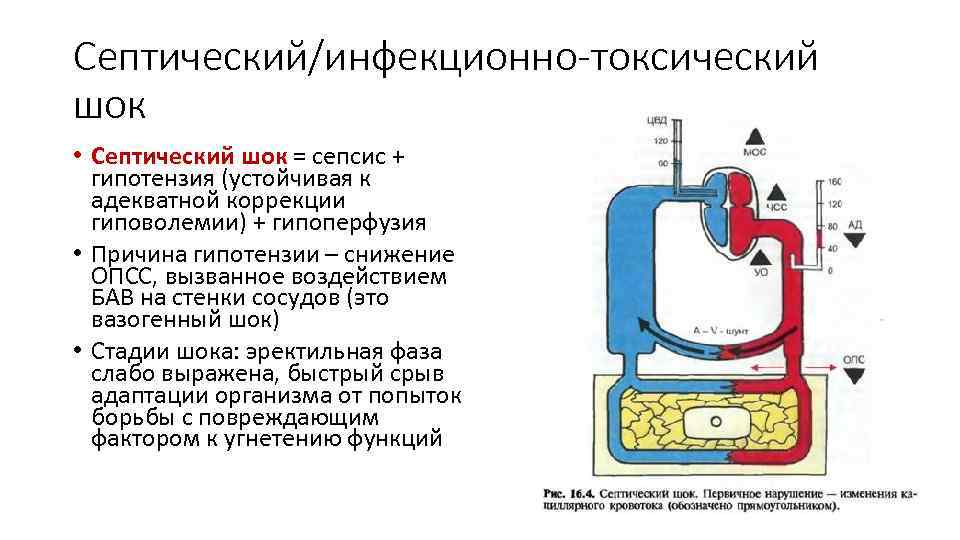 Септический/инфекционно-токсический шок • Септический шок = сепсис + гипотензия (устойчивая к адекватной коррекции гиповолемии)