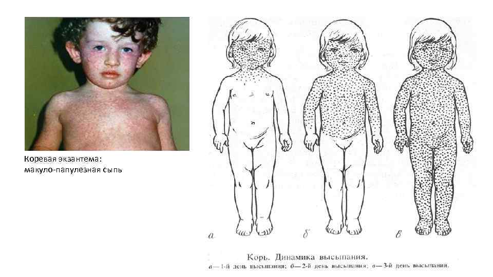 Коревая экзантема: макуло-папулезная сыпь 