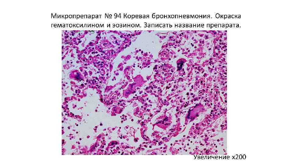 Полиомиелит патологическая анатомия презентация