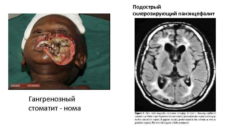 Подострый склерозирующий панэнцефалит Гангренозный стоматит - нома 