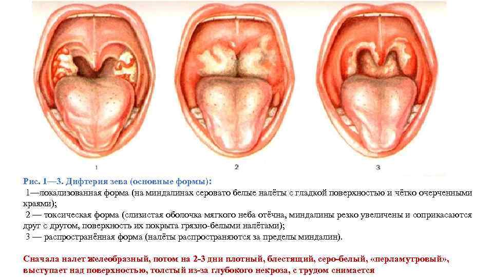 Рис. 1— 3. Дифтерия зева (основные формы): 1—локализованная форма (на миндалинах серовато белые налёты