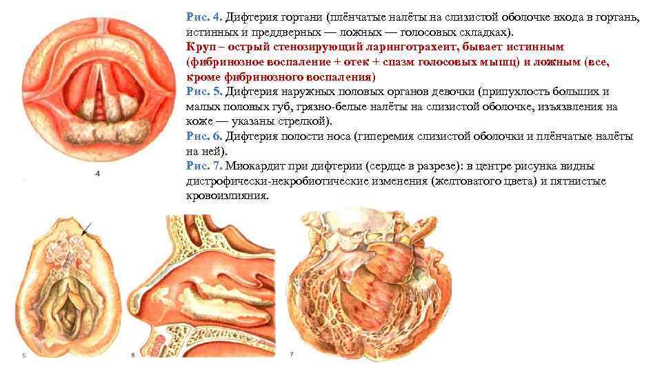 Рис. 4. Дифтерия гортани (плёнчатые налёты на слизистой оболочке входа в гортань, истинных и