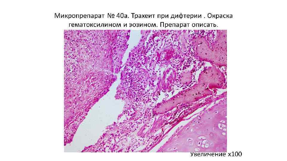 Дифтерия микроскопическая картина