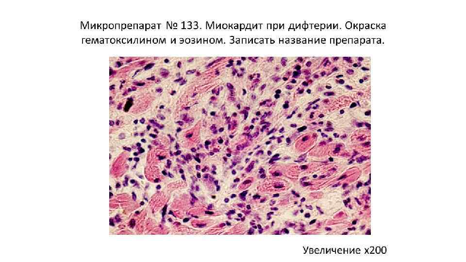 Полиомиелит патологическая анатомия презентация