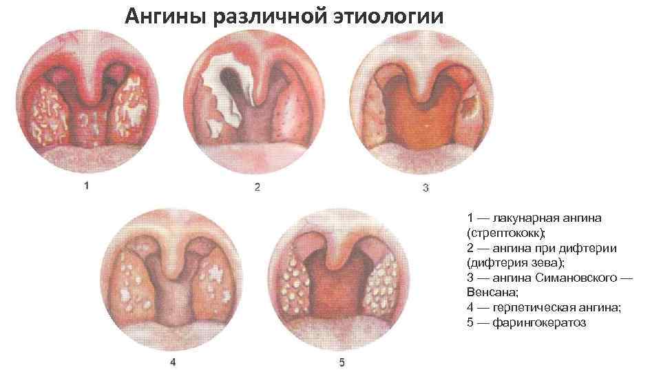 Ангины различной этиологии 1 — лакунарная ангина (стрептококк); 2 — ангина при дифтерии (дифтерия