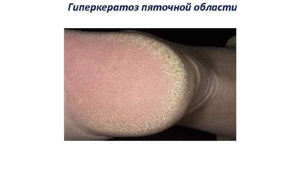 Гиперкератоз пяточной области 
