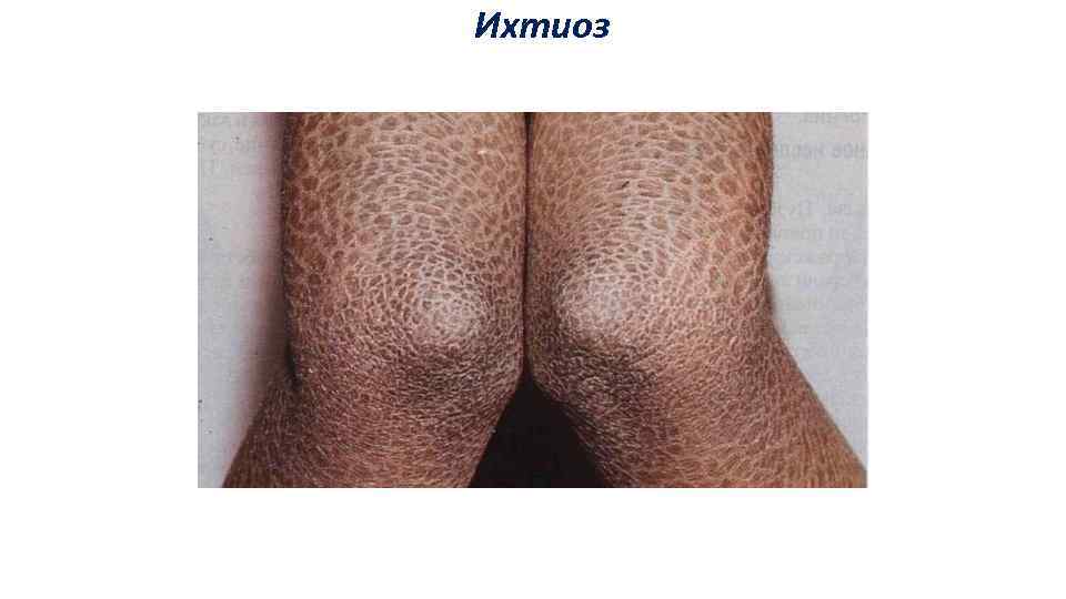 Ихтиоз 
