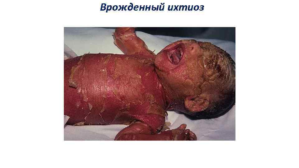 Врожденный ихтиоз 