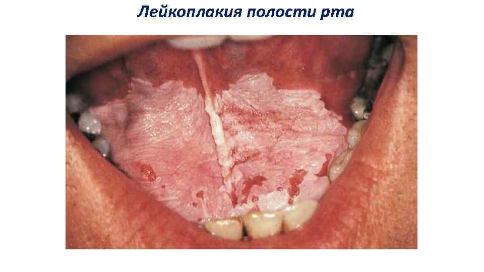 Лейкоплакия полости рта 