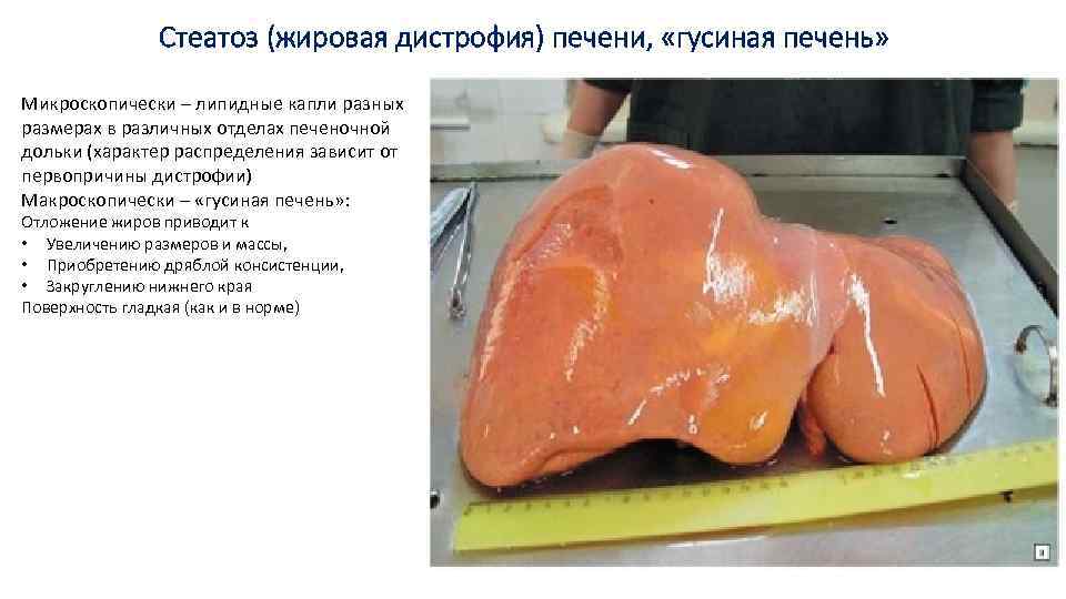 Стеатоз (жировая дистрофия) печени, «гусиная печень» Микроскопически – липидные капли разных размерах в различных
