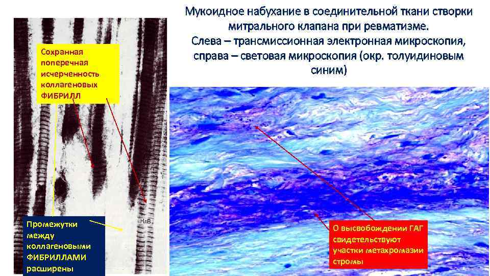 Сохранная поперечная исчерченность коллагеновых ФИБРИЛЛ Промежутки между коллагеновыми ФИБРИЛЛАМИ расширены Мукоидное набухание в соединительной
