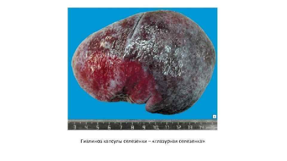 Гиалиноз капсулы селезенки – «глазурная селезенка» 