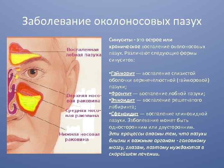 Причины заболевания носа. Болезнь носовой синусит. Воспалительные заболевания носовой полости. Симптомы воспаления верхнечелюстной гайморовой пазухи. Риносинусит острый риносинусит.