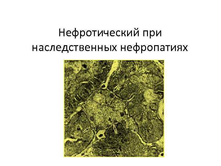 Нефротический при наследственных нефропатиях 